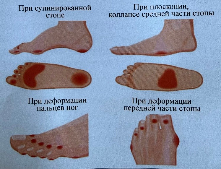 Диабет